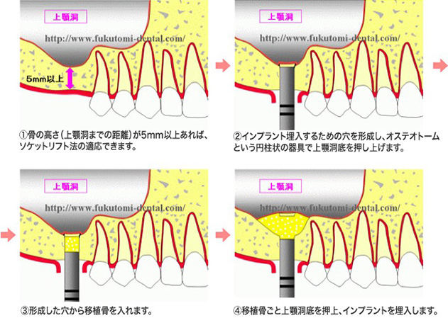 上顎洞挙上術(ソケットリフト法)