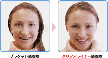 クリアアライナービフォアーアフター