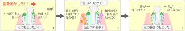 骨の代謝を利用して歯を動かす