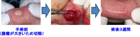 粘膜嚢胞（唇や頬などに出来る腫瘍）の手術例