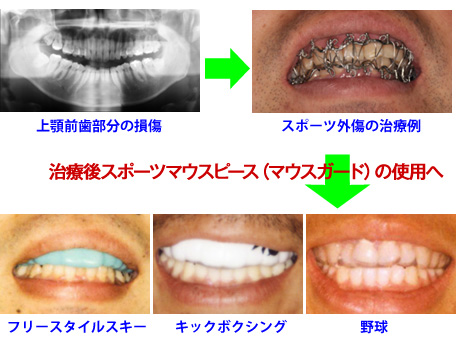 スポーツ外傷とスポーツマウスピース（マウスガード）