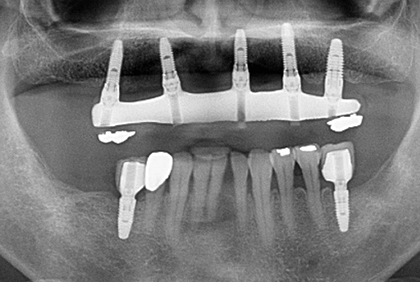 上顎フルマウスと下顎2本のインプラント症例のAFTER画像