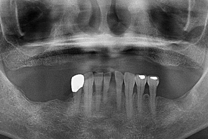 上顎フルマウスと下顎2本のインプラント症例のBEFORE画像