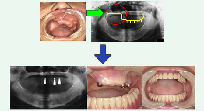 インプラントオーバーデンチャーの写真