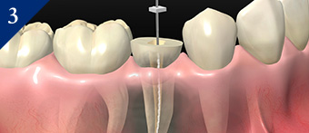 重度のむし歯でも歯を残せる治療（根管治療）を行います