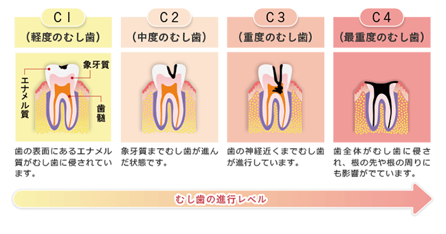 むし歯はこのように進行