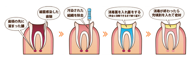 根管治療の流れ