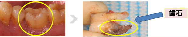 このように歯の根元にこびりついてしまった歯石を、完全に取り除くことは不可能です。