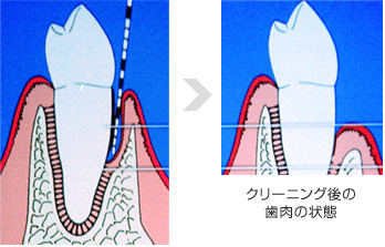 クリーニングによる歯周病治療の効果と注意事項