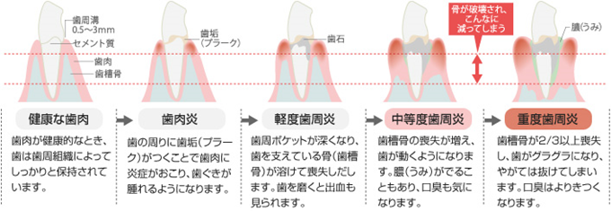 歯周病かな？と思ったら歯周病チェック