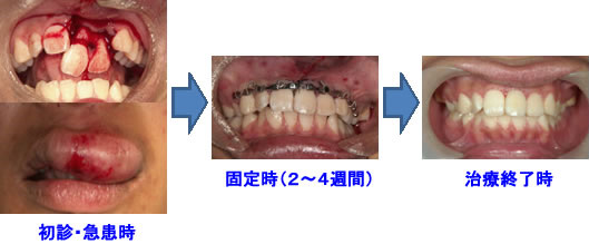 歯牙脱臼